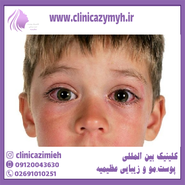 علائم ورم چشم در کودکان چیست؟